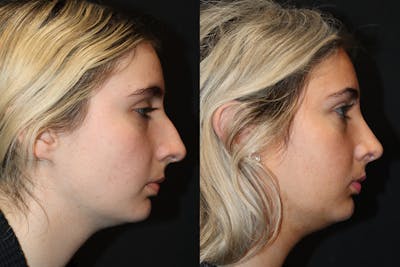 Rhinoplasty Before & After Gallery - Patient 136275 - Image 1