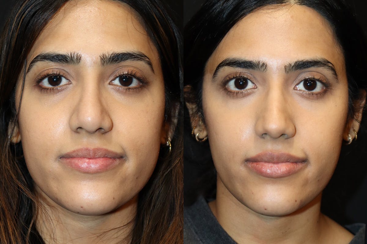 Rhinoplasty Before & After Gallery - Patient 705542 - Image 2
