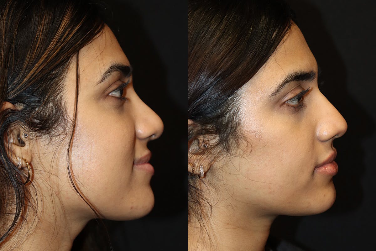 Rhinoplasty Before & After Gallery - Patient 705542 - Image 1