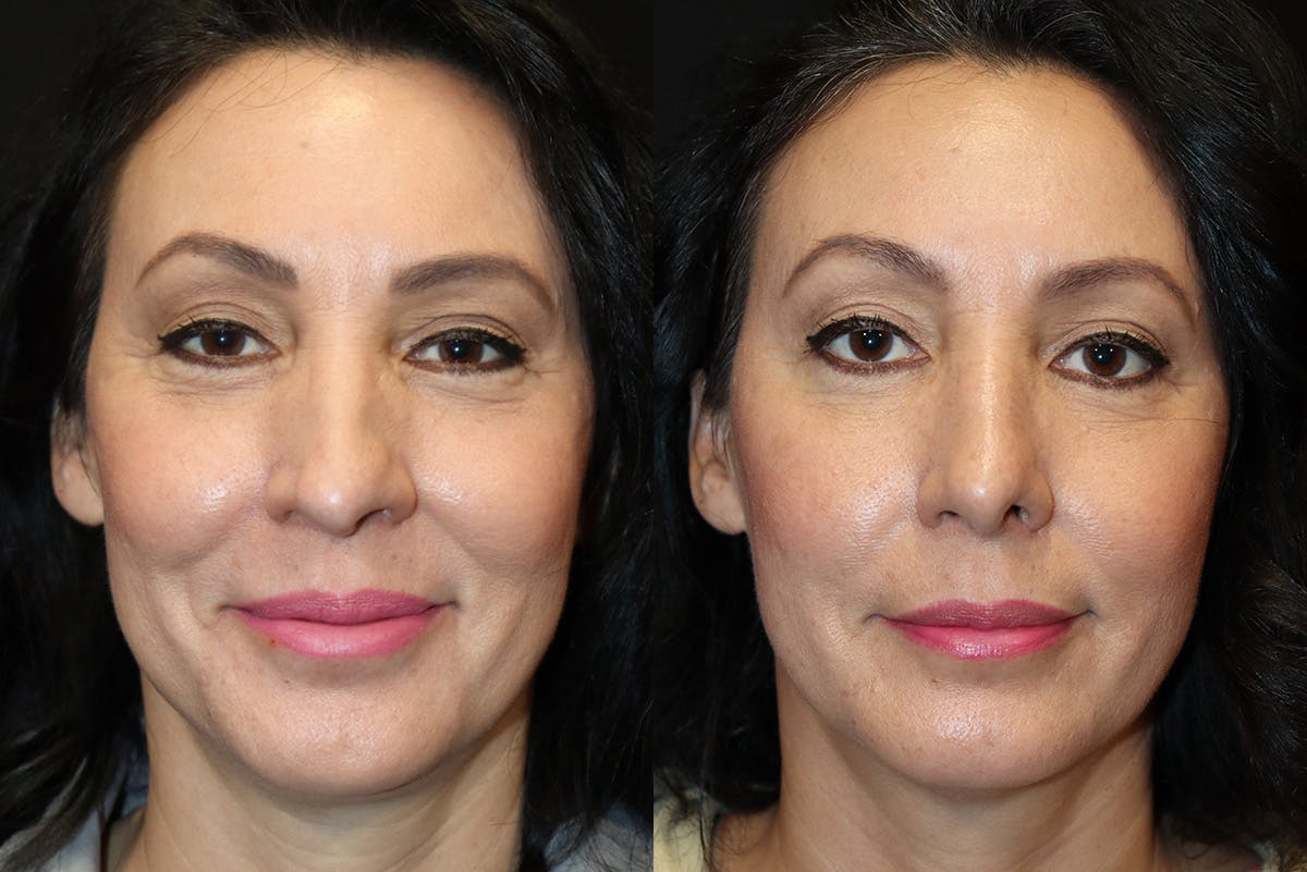Rhinoplasty Before & After Gallery - Patient 129572 - Image 2