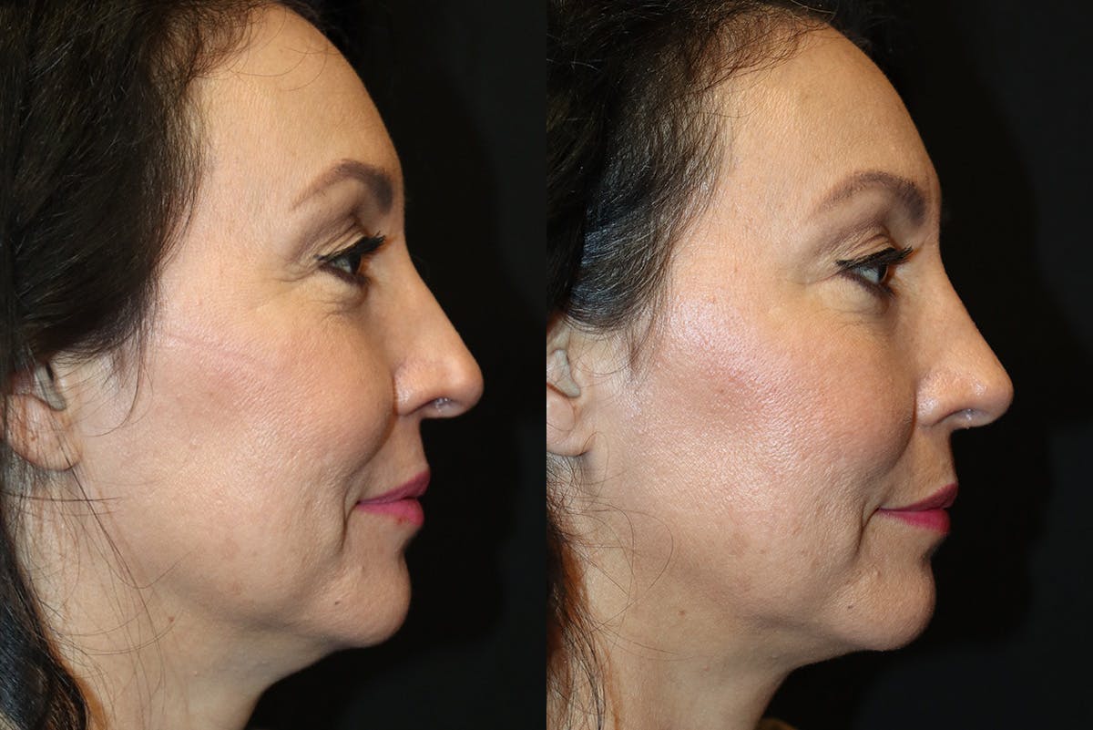 Rhinoplasty Before & After Gallery - Patient 129572 - Image 1