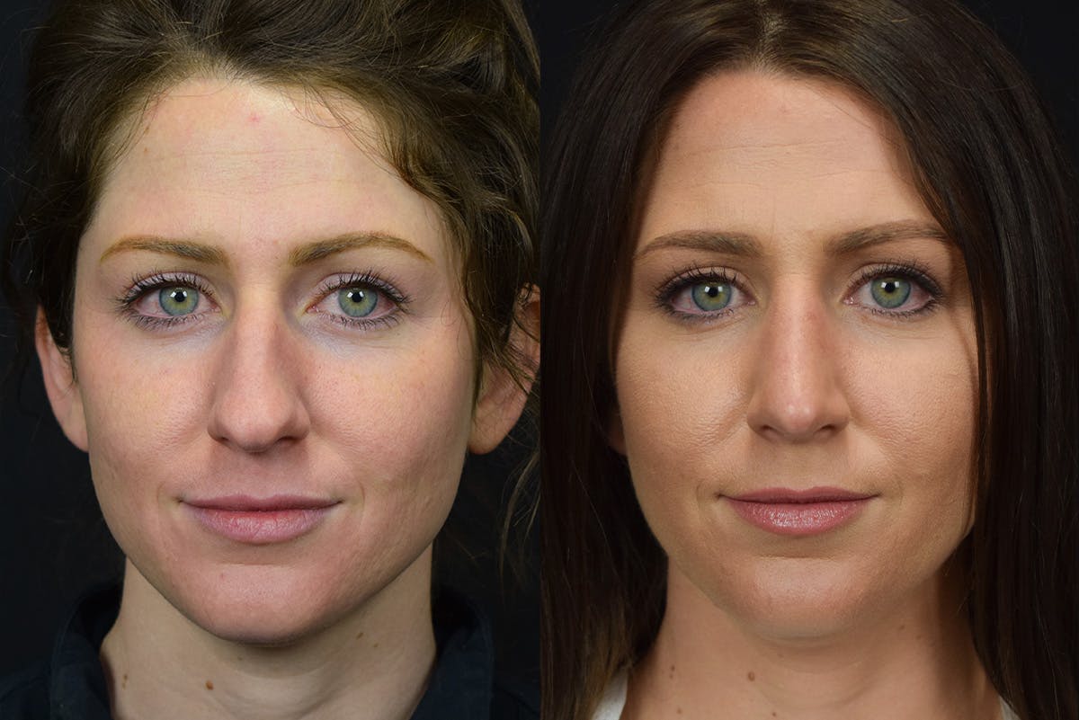 Rhinoplasty Before & After Gallery - Patient 596706 - Image 2