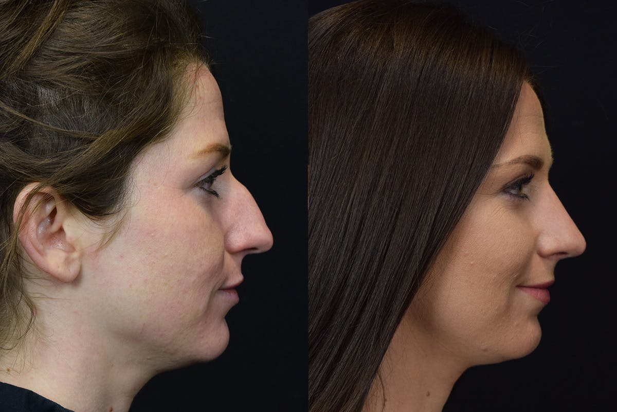 Rhinoplasty Before & After Gallery - Patient 596706 - Image 1