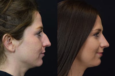 Rhinoplasty Before & After Gallery - Patient 596706 - Image 1