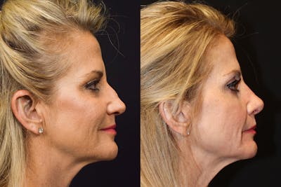 Rhinoplasty Before & After Gallery - Patient 268527 - Image 1