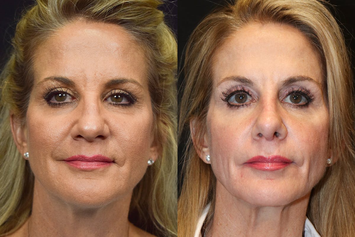 Rhinoplasty Before & After Gallery - Patient 268527 - Image 2