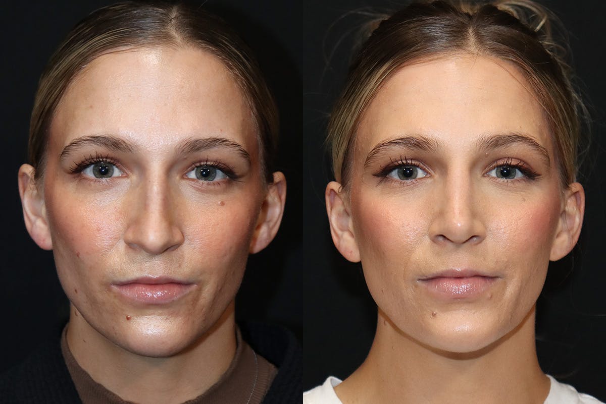 Rhinoplasty Before & After Gallery - Patient 282119 - Image 2