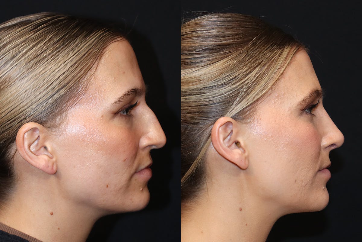 Rhinoplasty Before & After Gallery - Patient 282119 - Image 1
