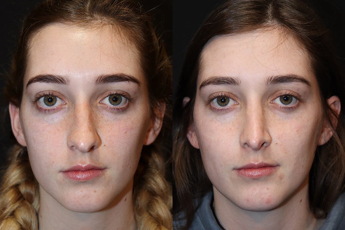 Rhinoplasty Before & After Gallery - Patient 266320 - Image 2