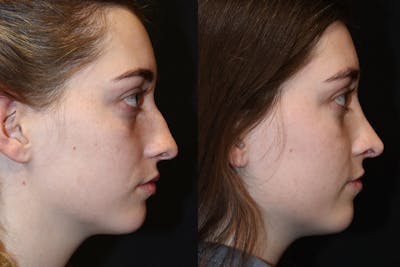 Rhinoplasty Before & After Gallery - Patient 266320 - Image 1