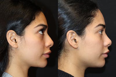 Rhinoplasty Before & After Gallery - Patient 193148 - Image 1