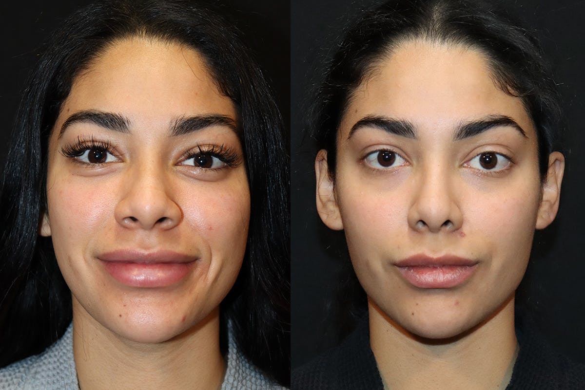 Rhinoplasty Before & After Gallery - Patient 193148 - Image 2