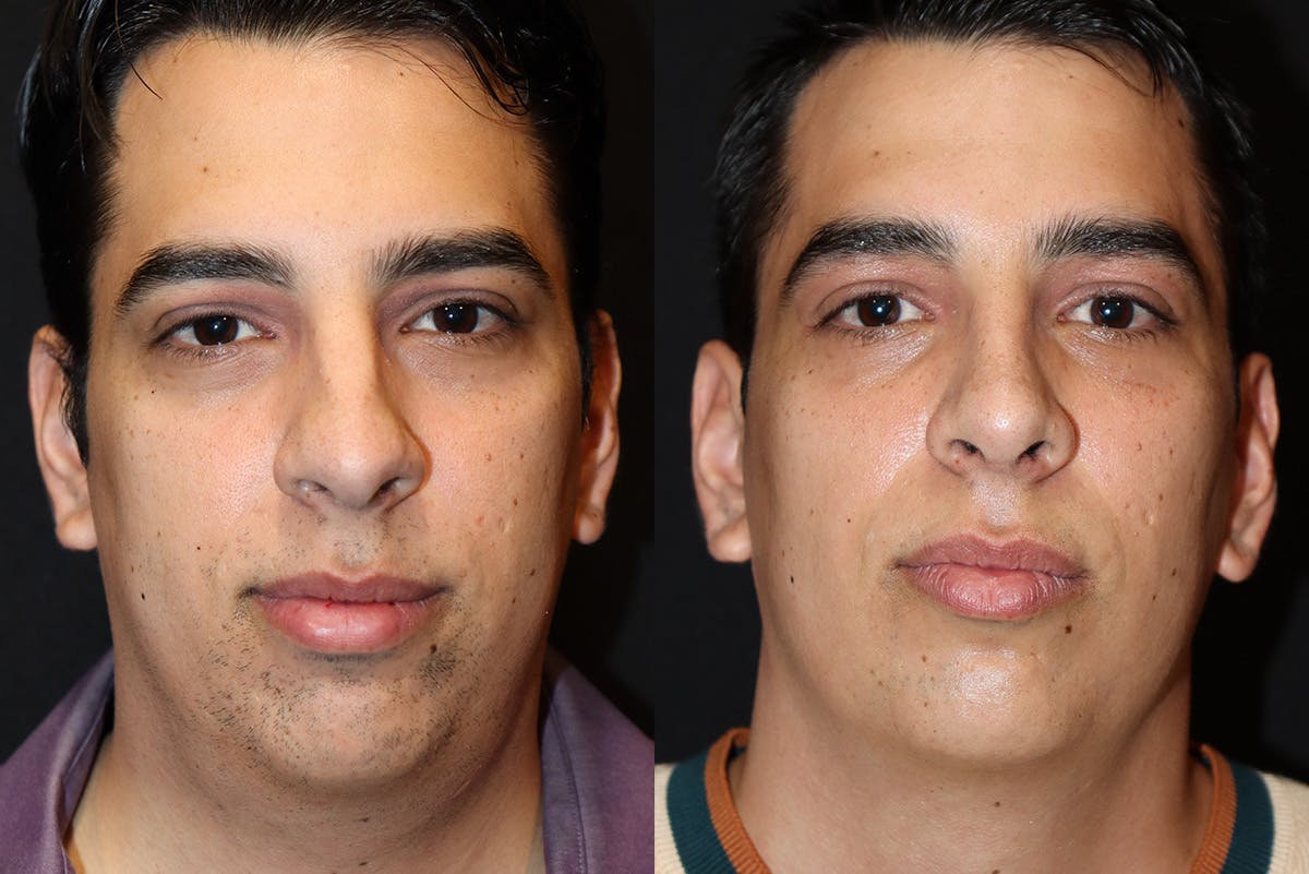 Rhinoplasty Before & After Gallery - Patient 291289 - Image 2