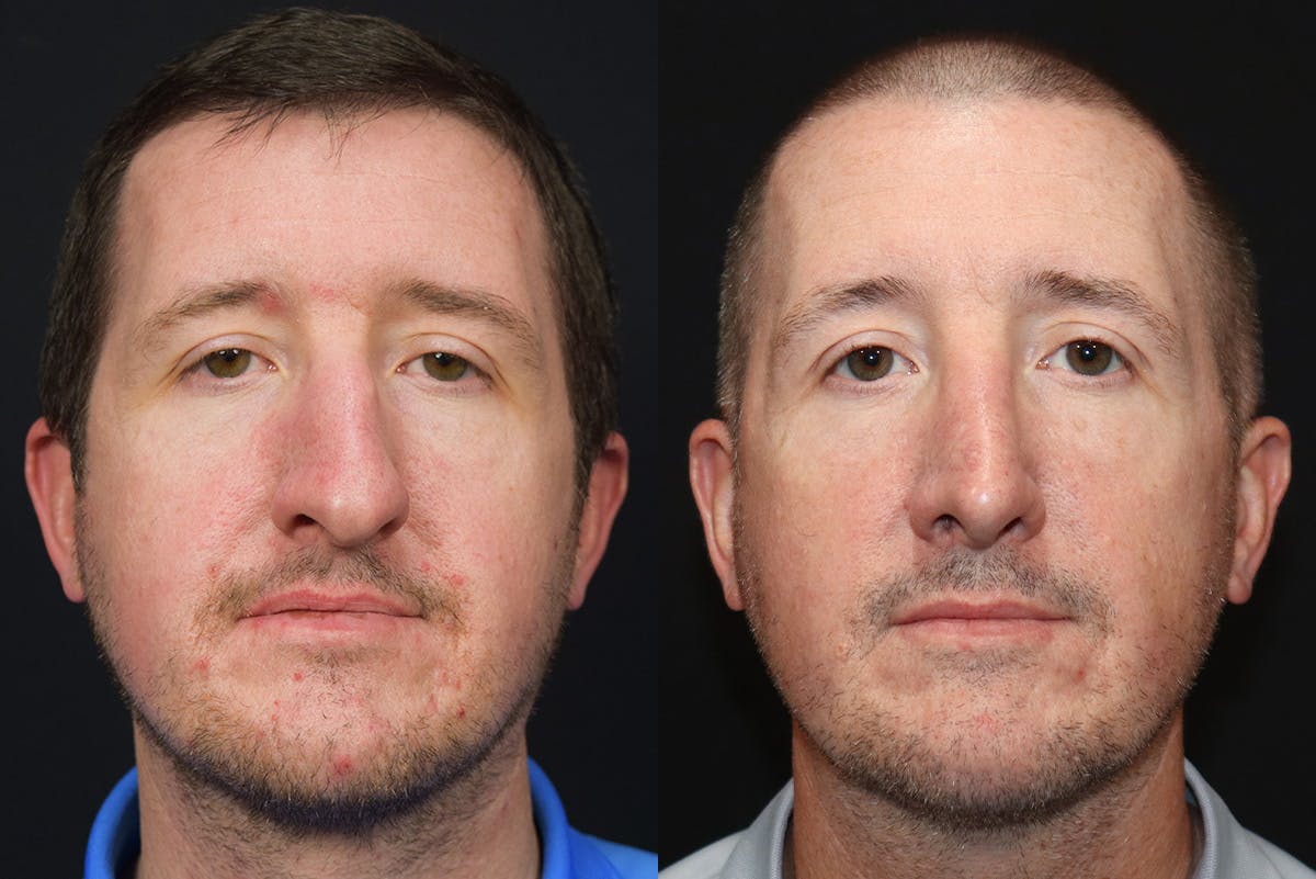 Rhinoplasty Before & After Gallery - Patient 327215 - Image 2