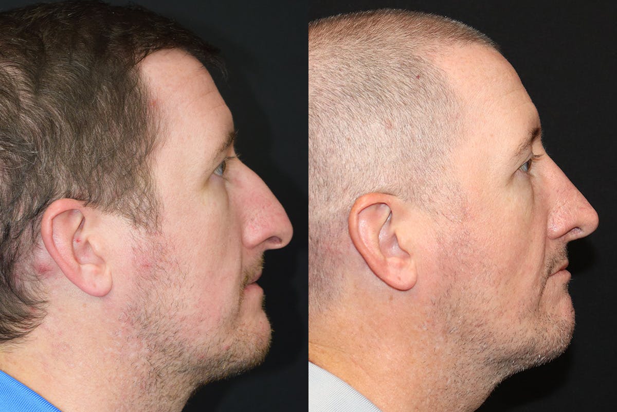 Rhinoplasty Before & After Gallery - Patient 327215 - Image 1