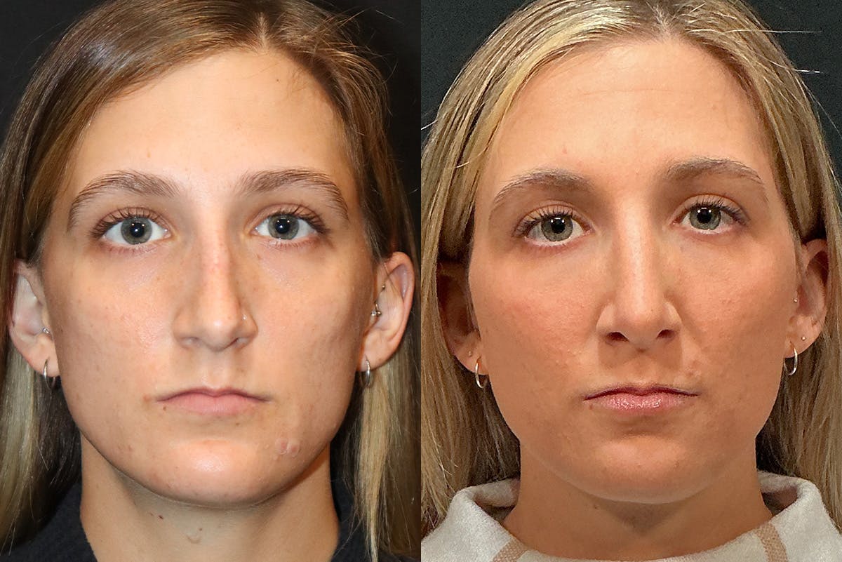 Rhinoplasty Before & After Gallery - Patient 321802 - Image 2