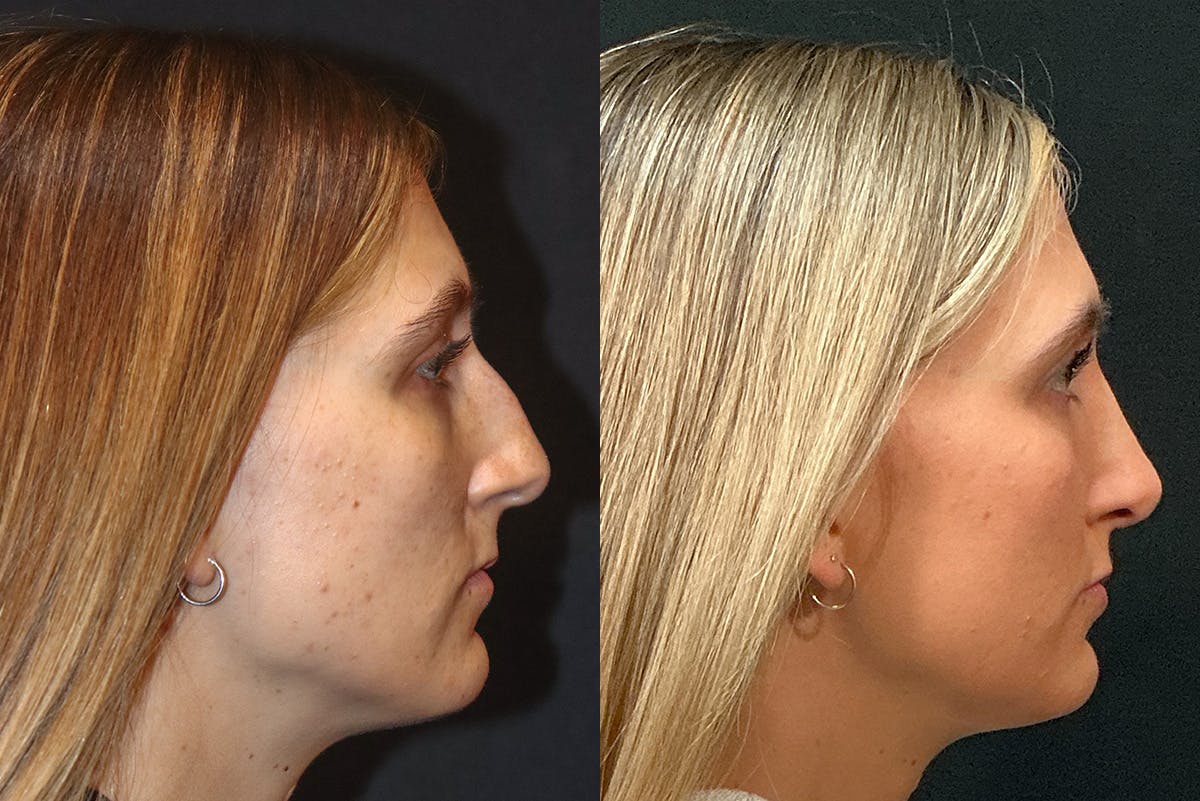 Rhinoplasty Before & After Gallery - Patient 321802 - Image 1