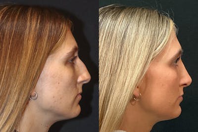 Rhinoplasty Before & After Gallery - Patient 321802 - Image 1