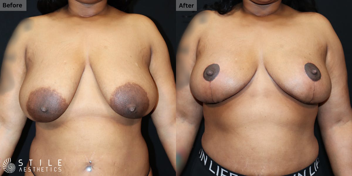 Breast Reduction Before & After Gallery - Patient 195985 - Image 1