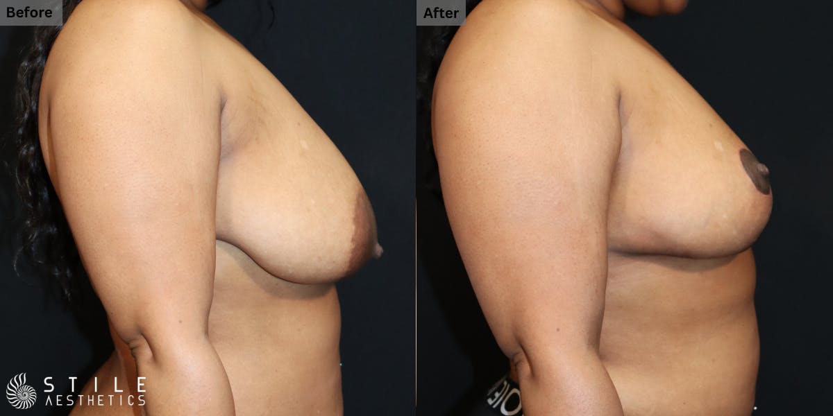 Breast Reduction Before & After Gallery - Patient 195985 - Image 2