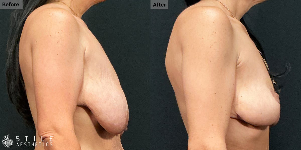 Breast Reduction Before & After Gallery - Patient 387384 - Image 2