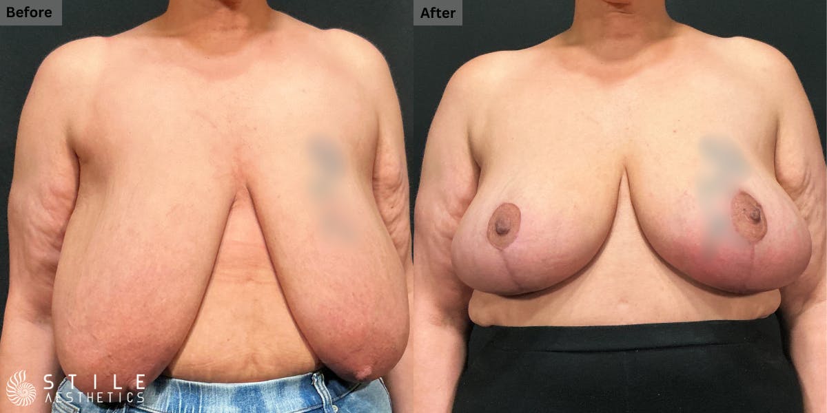 Breast Reduction Before & After Gallery - Patient 258739 - Image 1