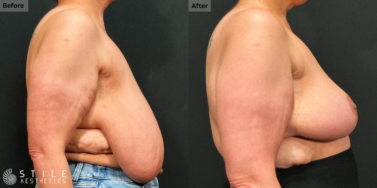 Breast Reduction Before & After Gallery - Patient 258739 - Image 2