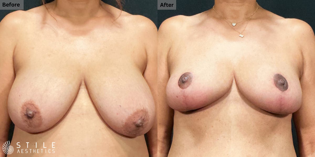 Breast Reduction Before & After Gallery - Patient 137398 - Image 1