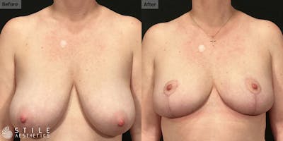 Breast Reduction Before & After Gallery - Patient 601764 - Image 1