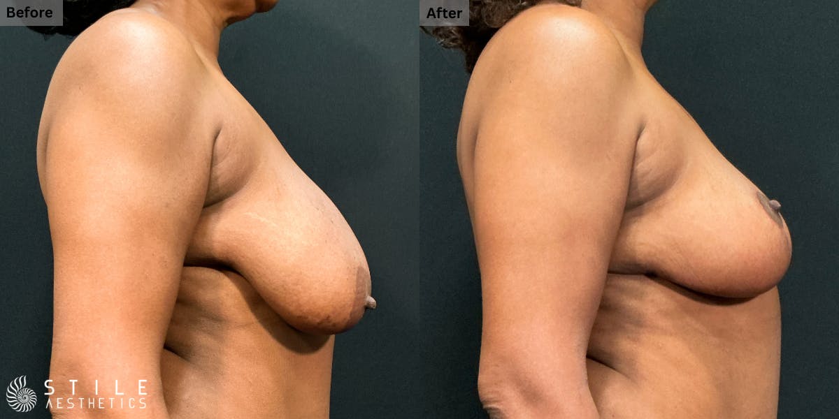 Breast Reduction Before & After Gallery - Patient 391185 - Image 2