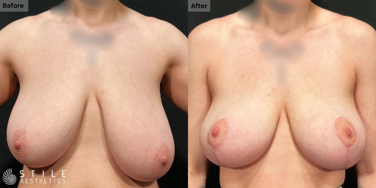 Breast Reduction Before & After Gallery - Patient 338754 - Image 1