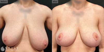 Breast Reduction Before & After Gallery - Patient 338754 - Image 1
