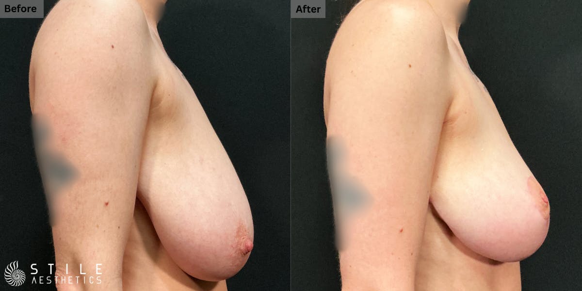 Breast Reduction Before & After Gallery - Patient 338754 - Image 2