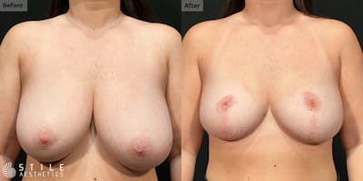 Breast Reduction Before & After Gallery - Patient 104238 - Image 1