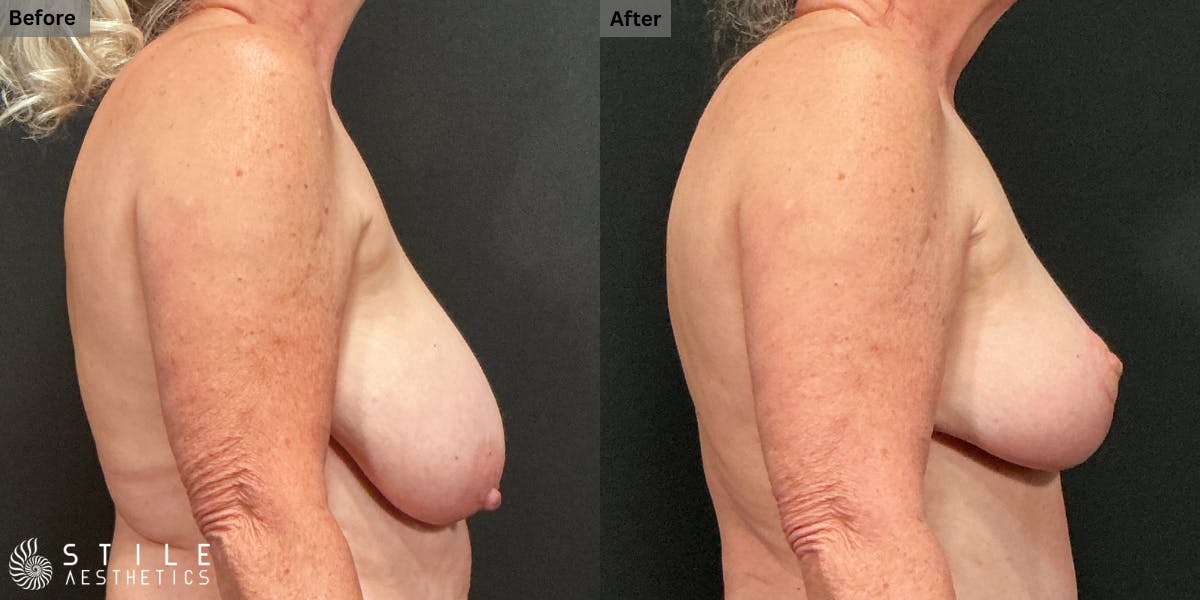 Breast Reduction Before & After Gallery - Patient 406980 - Image 2