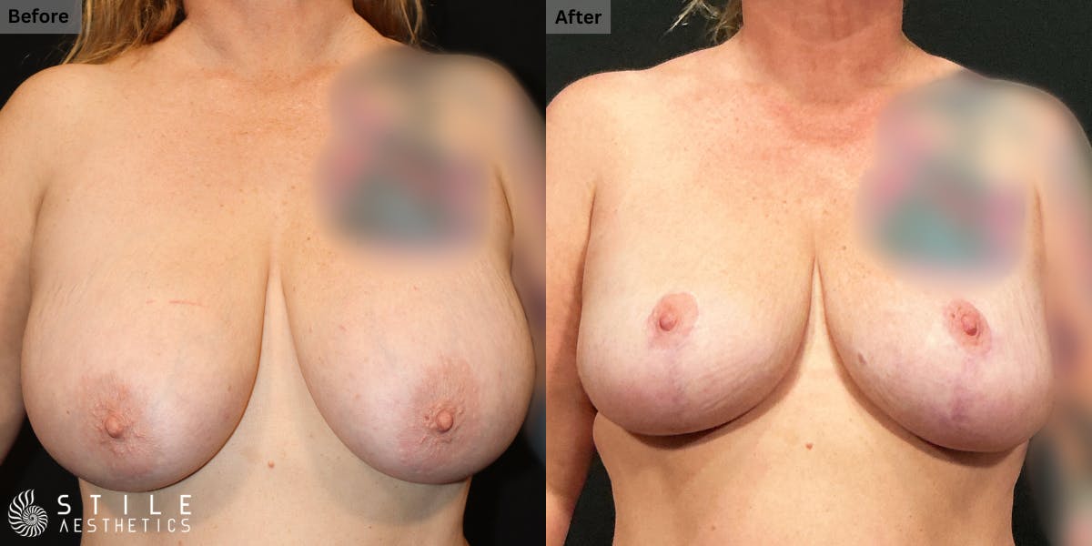 Breast Reduction Before & After Gallery - Patient 213152 - Image 1