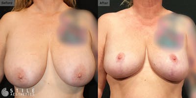 Breast Reduction Before & After Gallery - Patient 213152 - Image 1
