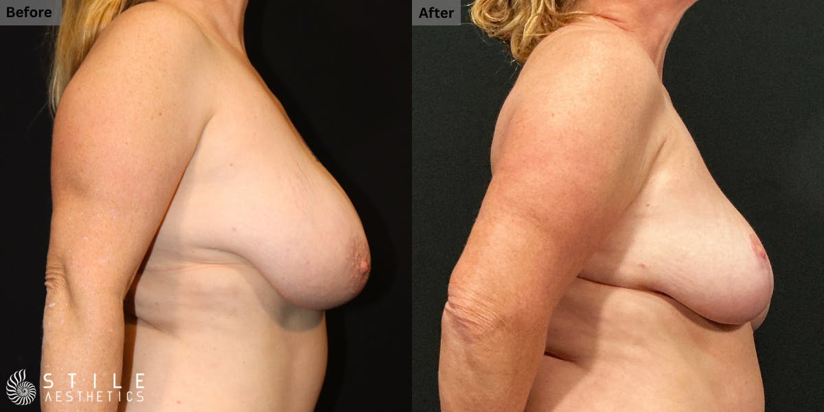 Breast Reduction Before & After Gallery - Patient 213152 - Image 2