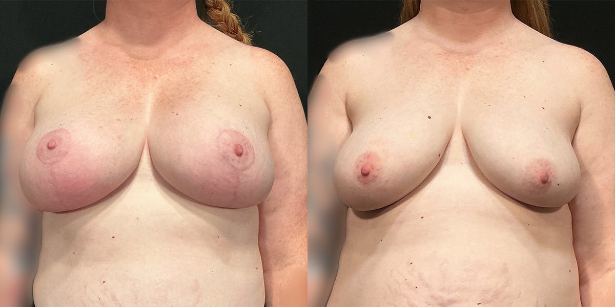 Breast Augmentation with Lift Before & After Gallery - Patient 144269 - Image 1