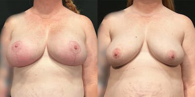 Breast Augmentation with Lift Before & After Gallery - Patient 144269 - Image 1
