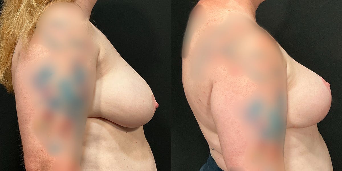 Breast Augmentation with Lift Before & After Gallery - Patient 144269 - Image 2