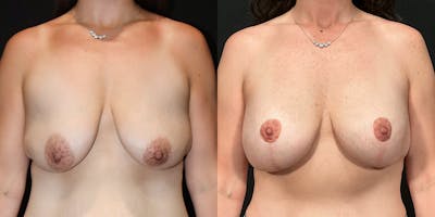 Breast Augmentation with Lift Before & After Gallery - Patient 378716 - Image 1