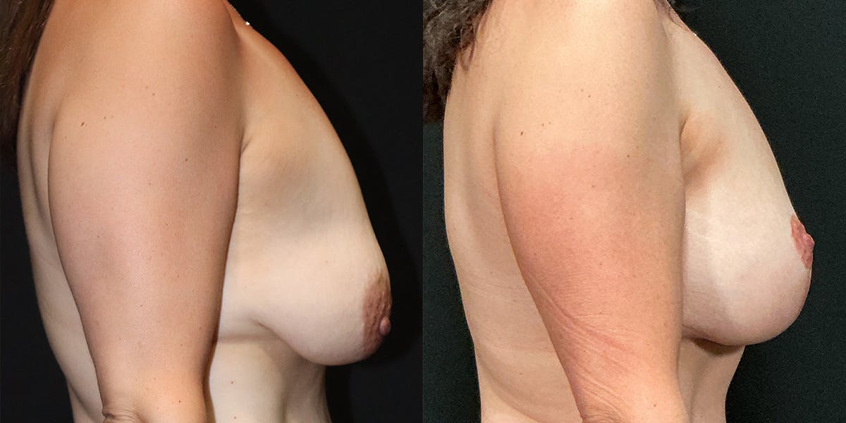 Breast Augmentation with Lift Before & After Gallery - Patient 378716 - Image 2