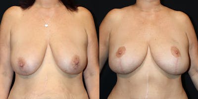 Breast Augmentation with Lift Before & After Gallery - Patient 154357 - Image 1