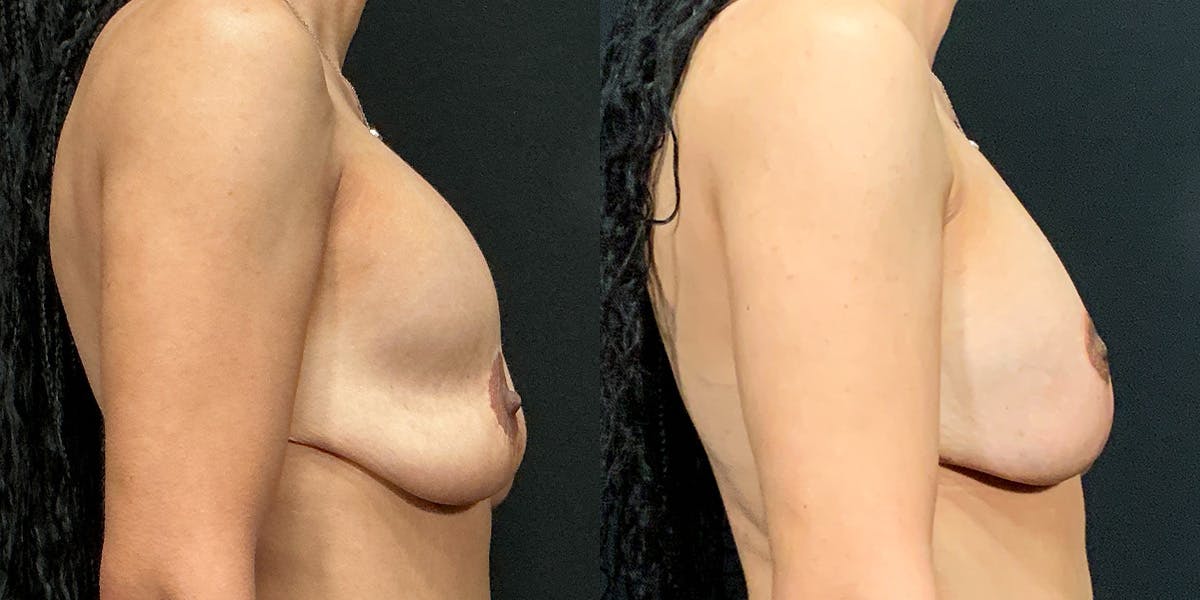 Breast Augmentation with Lift Before & After Gallery - Patient 167251 - Image 2