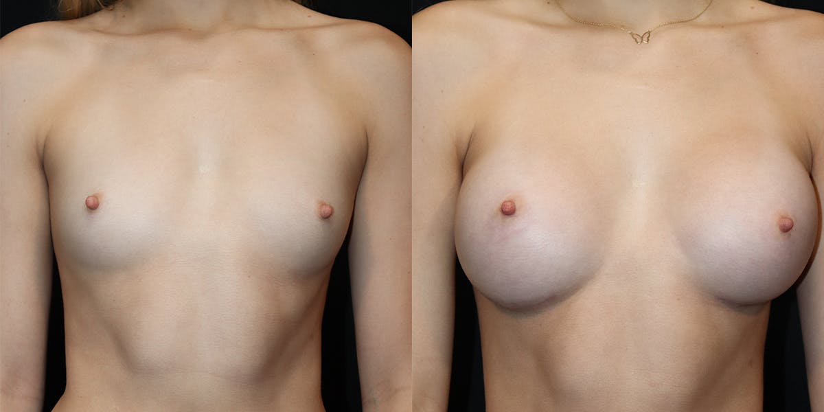 Breast Augmentation Before & After Gallery - Patient 417771 - Image 1