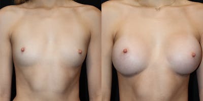 Breast Augmentation Before & After Gallery - Patient 417771 - Image 1