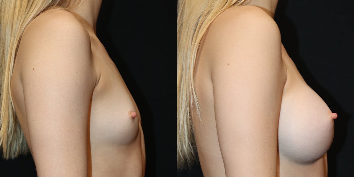 Breast Augmentation Before & After Gallery - Patient 417771 - Image 2