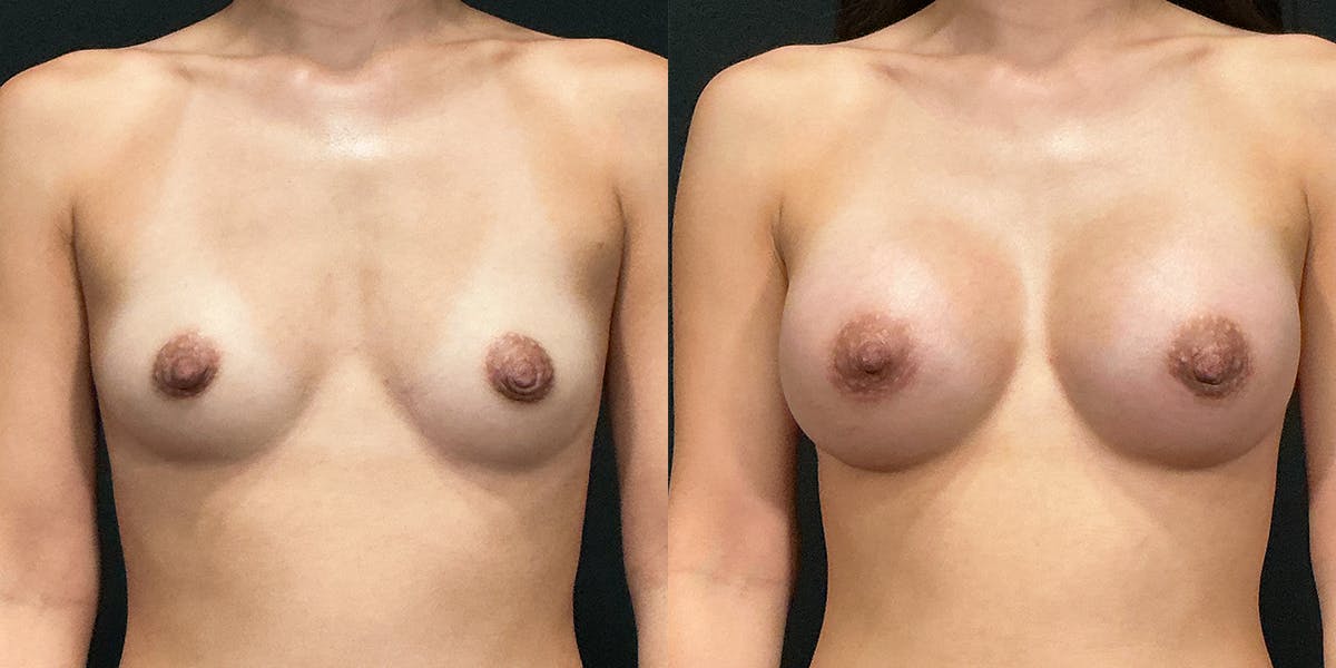 Breast Augmentation Before & After Gallery - Patient 456771 - Image 1
