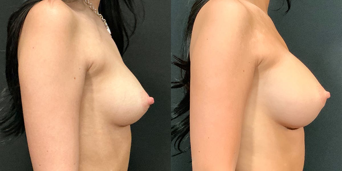 Breast Augmentation Before & After Gallery - Patient 346283 - Image 2